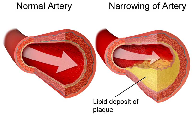 Holesterol u arterijama